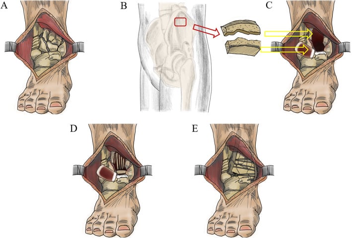 Structural osteochondral reconstruction of an unreconstructible pilon fracture