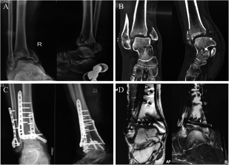 Radiographic and MRI outcome after osteochondral plafond reconstruction