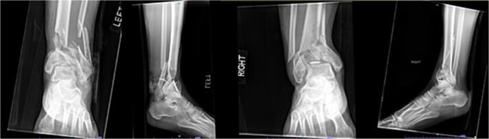 Bilateral open pilon fractures with asymmetric comminution