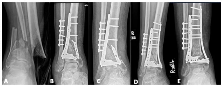 Aseptic pilon nonunion with progressive deformity and revision fixation