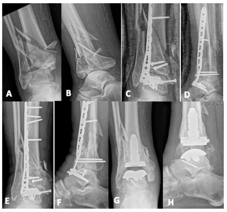 Pilon fracture treated by acute tibiotalar fusion, later revised to total ankle arthroplasty