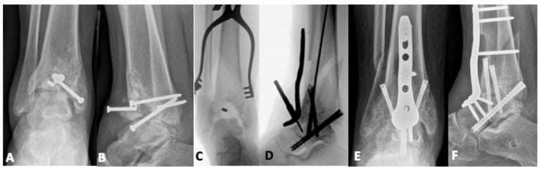 Malaligned pilon nonunion converted to tibiotalar arthrodesis