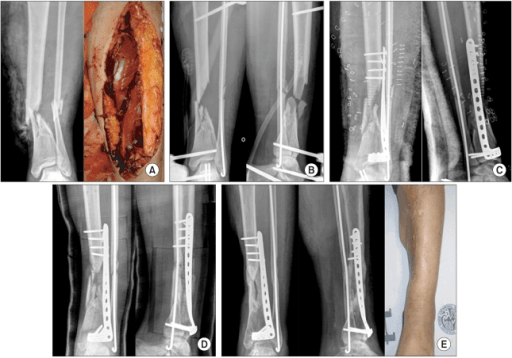 Staged management of a high-energy pilon fracture: injury, spanning external fixation, then definitive plate fixation