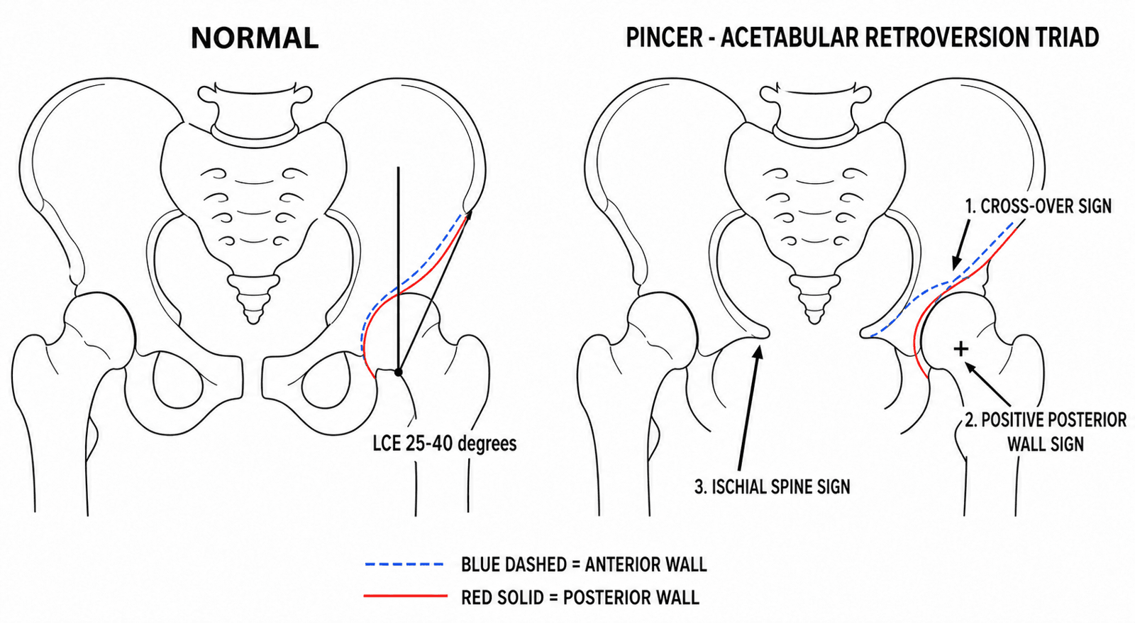 Labelled AP pelvis diagram comparing normal lateral center-edge angle measurement against the pincer acetabular retroversion triad: cross-over sign, positive posterior wall sign, and ischial spine sign