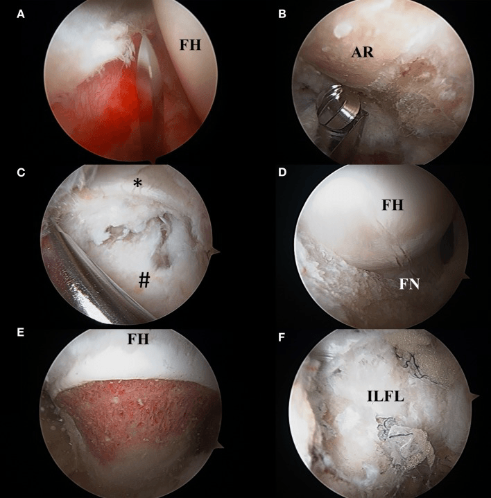 Arthroscopic views of capsulotomy, acetabular rim trimming with a burr, femoral head-neck exposure and resection, and the iliofemoral ligament