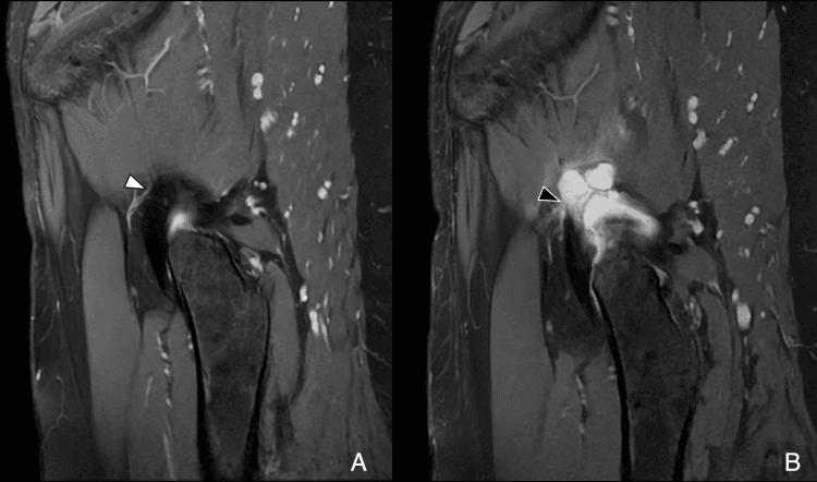 Preoperative and postoperative MRI showing capsular dehiscence after hip arthroscopy