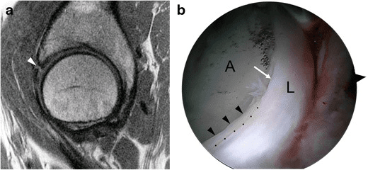 MRI and arthroscopic view showing chondrolabral separation and adjacent cartilage delamination in combined FAI