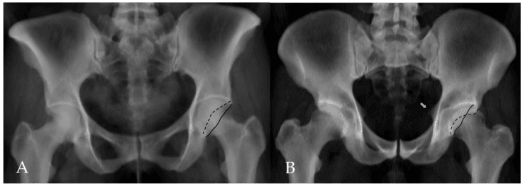 Virtual AP pelvis radiographs, one without a cross-over sign and one with a cross-over sign and an ischial spine sign