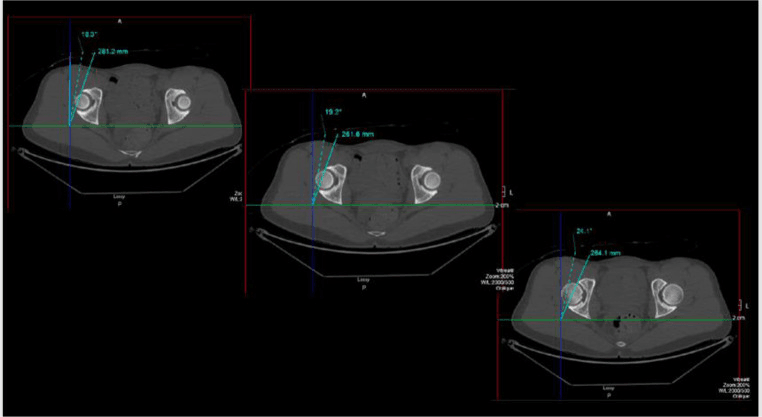 Three axial CT slices of the pelvis with acetabular version measured at the right hip on each