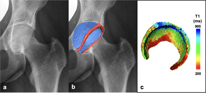 AP radiograph of a hip with pincer morphology, a three-dimensional model of its cartilage and labrum overlaid, and a colour-coded T1 map of the cartilage