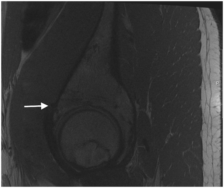 MRI showing medial cortical perforation by a suture anchor
