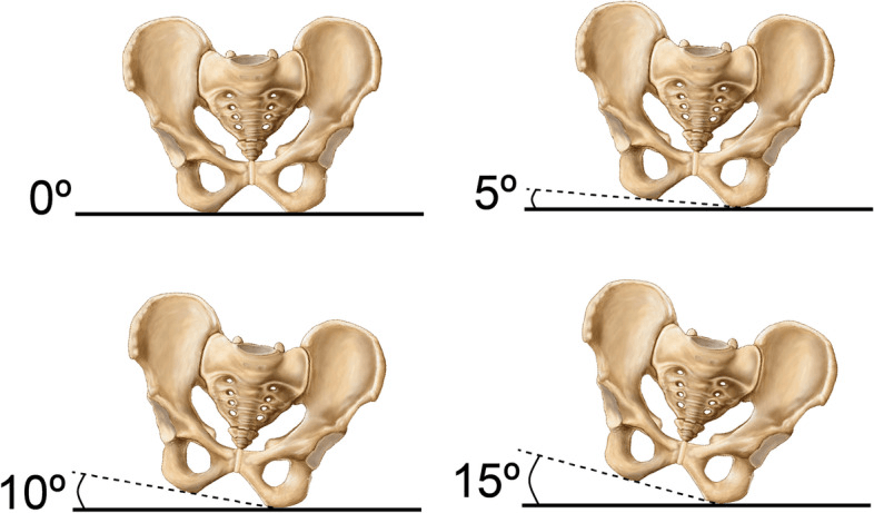 Pelvic models shown level and at 5, 10 and 15 degrees of obliquity against a horizontal reference line