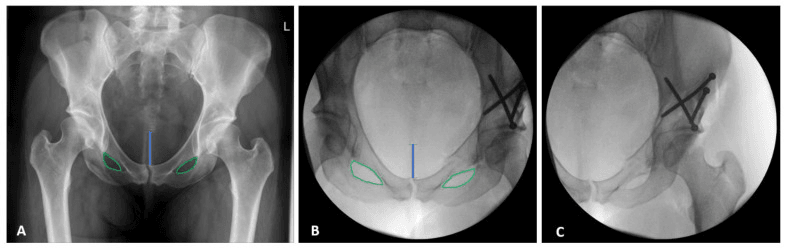 Preoperative AP pelvis and intraoperative fluoroscopy with the obturator foramina outlined in green and a blue line above the symphysis, and a fluoroscopic view of the hip