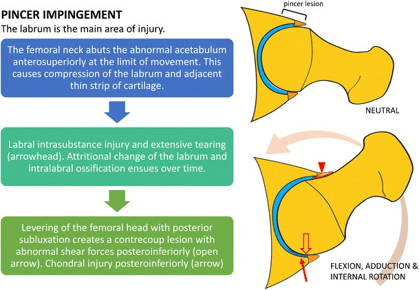 Diagram of pincer impingement: the femoral neck abutting the acetabulum anterosuperiorly in flexion, adduction and internal rotation, with labral injury and a posteroinferior contre-coup lesion