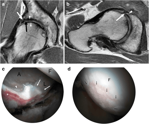 MRI and arthroscopic images of labral degeneration, chondrolabral separation and cartilage wear