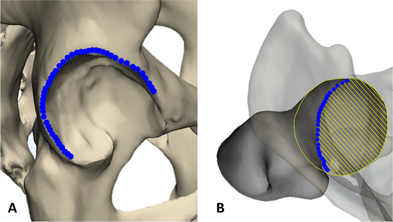 Three-dimensional pelvic model with the acetabular rim traced in blue points and the covered area of the femoral head hatched
