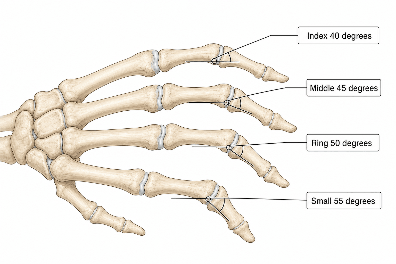 Skeletal hand diagram showing the PIP joint of each finger fused at progressively increasing flexion angles from the index to small finger