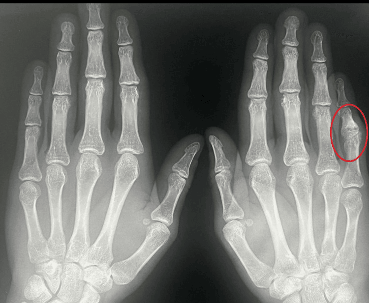 Frontal radiographs of both hands with a red circle around the small-finger PIP joint of one hand