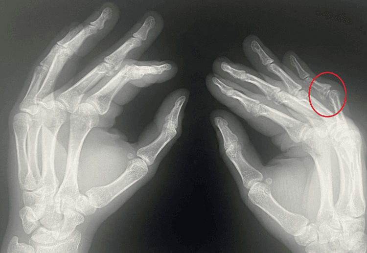 Second radiographic projection of both hands with the fingers spread and a red circle around the affected PIP joint