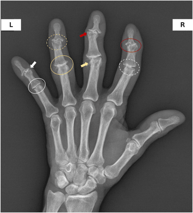 Hand radiograph with coloured circles and arrows marking changes at the PIP and DIP joints in erosive osteoarthritis