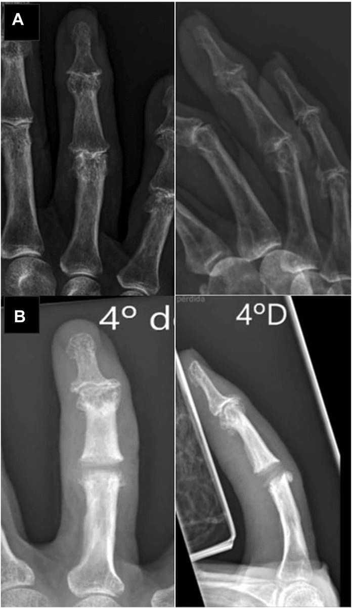 Radiographs of a finger with PIP arthritis before arthroplasty (panel A) and after PIP arthroplasty (panel B)