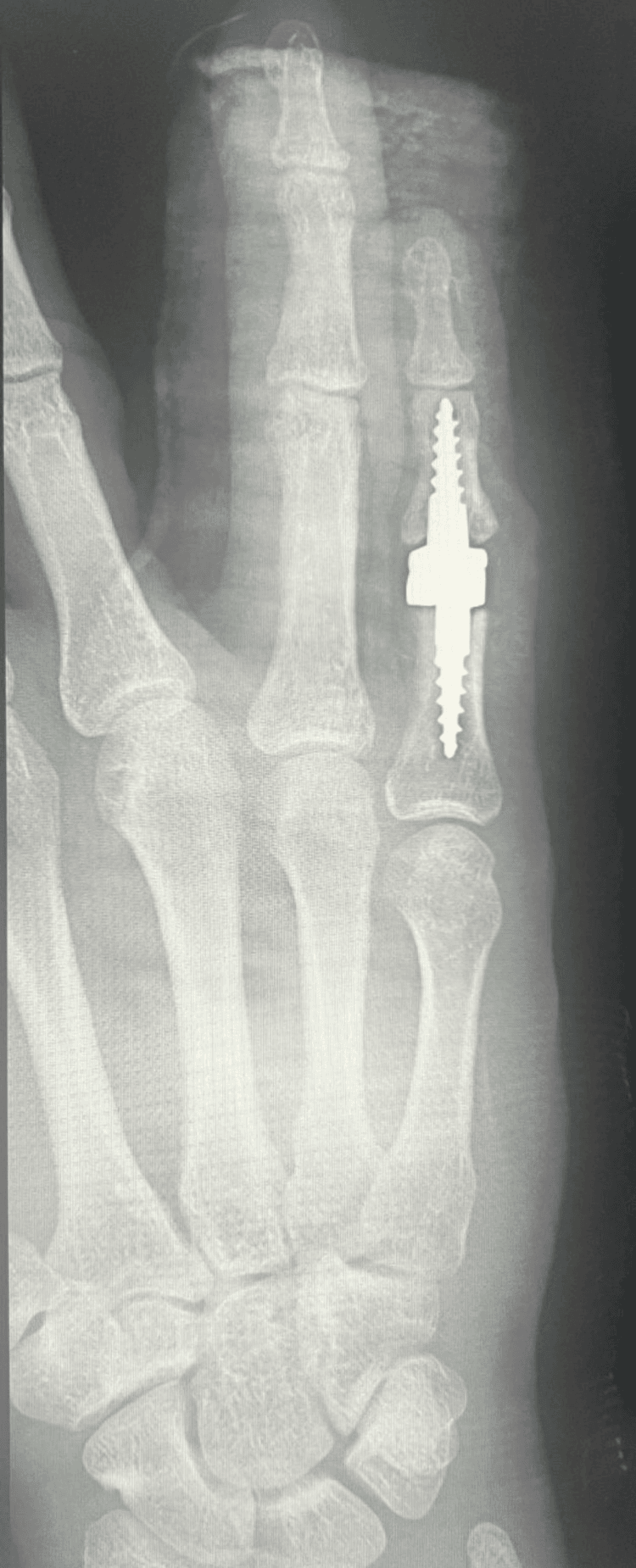 Second postoperative radiograph of the hand showing a stemmed small-finger PIP implant
