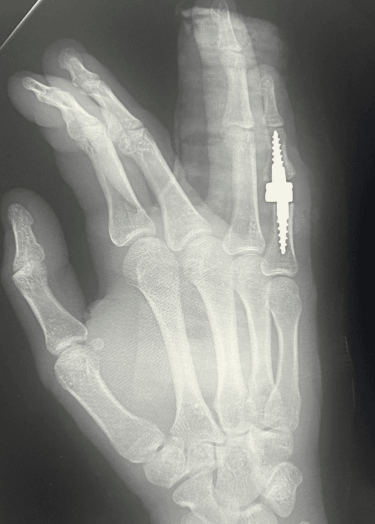 Postoperative hand radiograph with a stemmed implant at the small-finger PIP joint