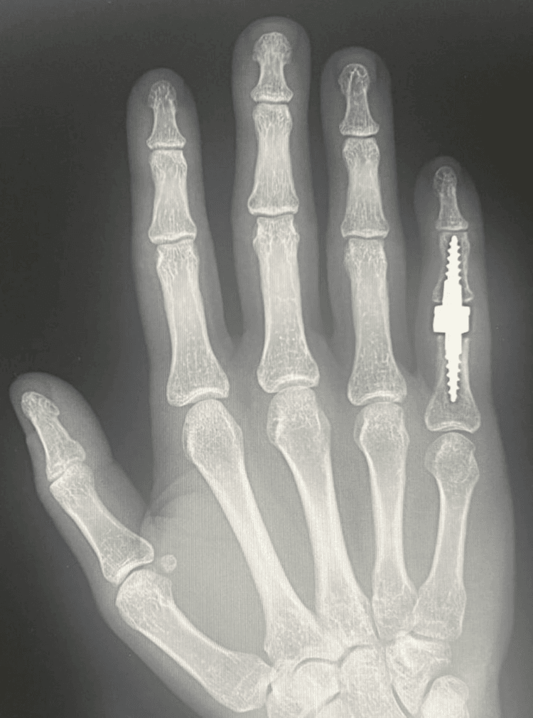 Frontal radiograph of the whole hand with a stemmed small-finger PIP implant in place