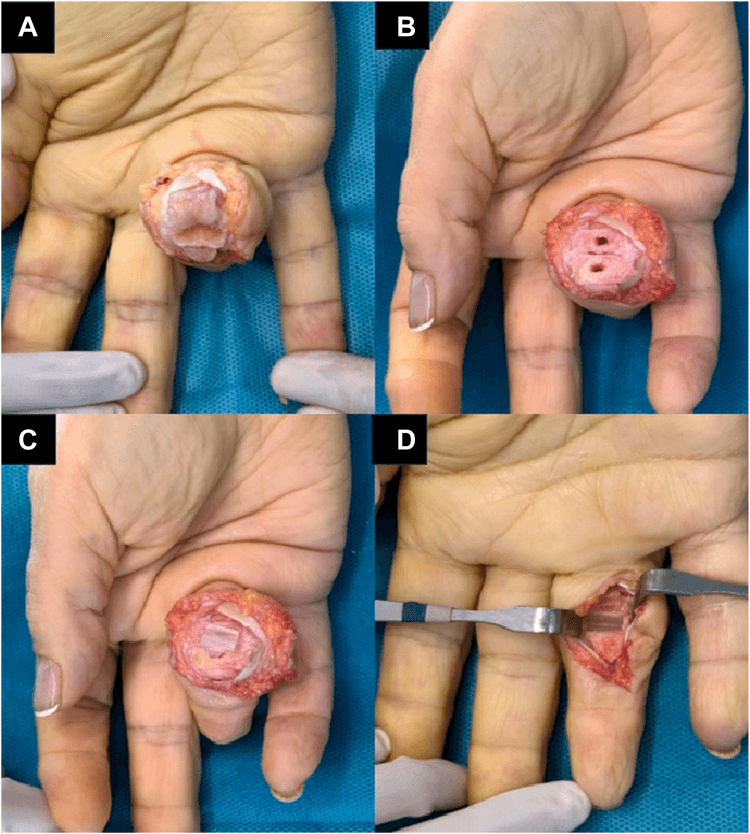 Four operative photographs, panels A to D, of a volar approach to the PIP joint seen from the palm