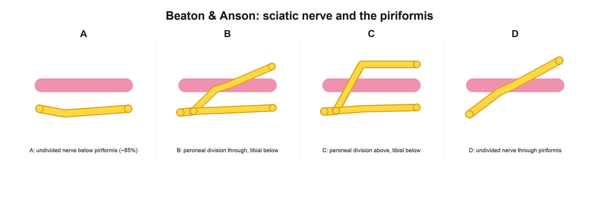 Schematic of the Beaton and Anson types A to D showing the sciatic nerve relationship to the piriformis muscle: undivided below, peroneal division through, peroneal division above, and undivided through
