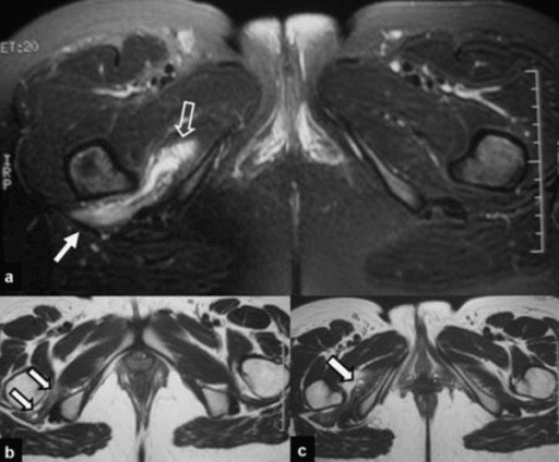 Axial and coronal MRI showing a quadratus femoris tear with haematoma and extension into the obturator internus