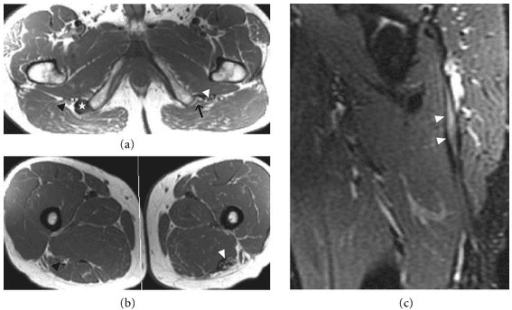 Axial and coronal MRI of a proximal hamstring-origin tear with adjacent sciatic nerve scarring