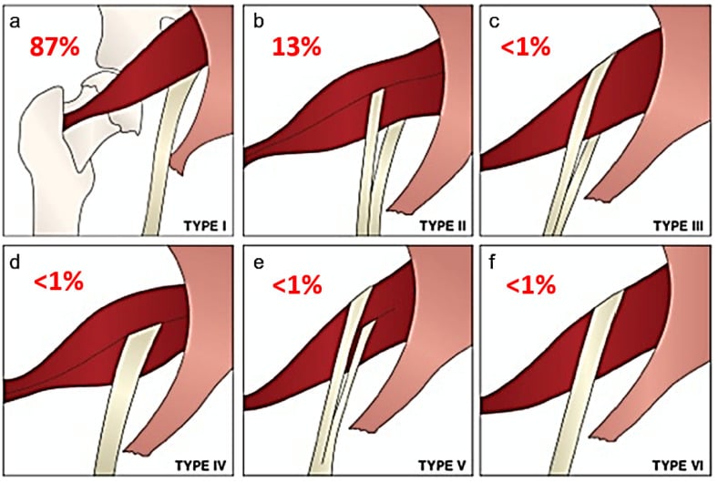 Six-panel Beaton and Anson classification showing sciatic nerve relationships to the piriformis with estimated prevalence