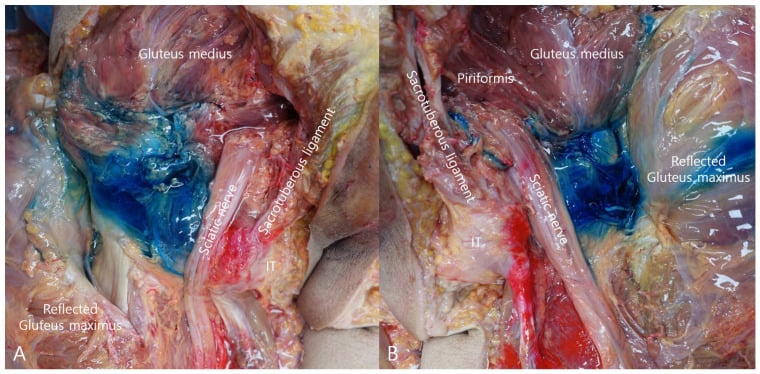 Paired posterior cadaveric dissections showing blue injectate spreading through the deep gluteal space around piriformis and the sciatic nerve