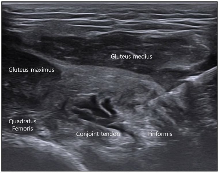 Labelled ultrasound image showing gluteus maximus, gluteus medius, piriformis, conjoint tendon and quadratus femoris during deep-gluteal injection