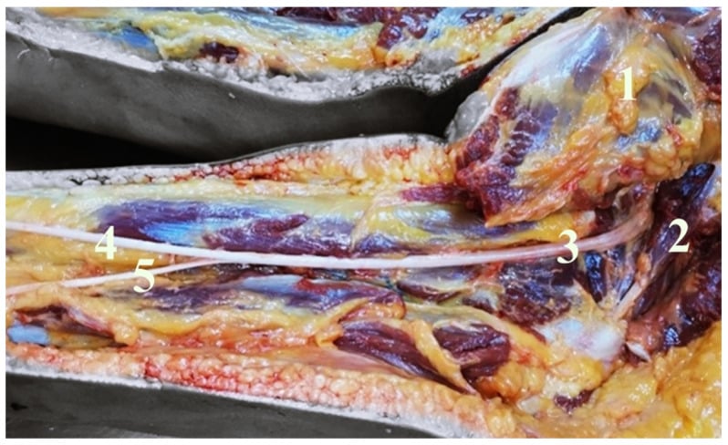 Posterior cadaveric gluteal dissection showing piriformis and the sciatic nerve dividing into tibial and common fibular components
