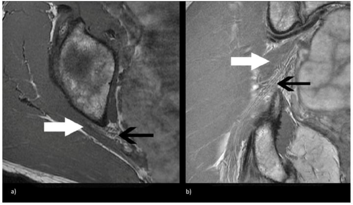 Axial and coronal MR neurography showing a normal sciatic nerve anterior and inferior to the piriformis