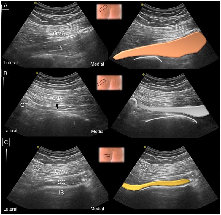 Three paired ultrasound and colour-overlay panels identifying piriformis muscle, piriformis tendon and superior gemellus