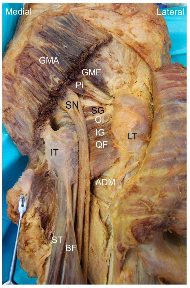 Labelled posterior cadaveric hip dissection showing piriformis, sciatic nerve, short external rotators, ischial tuberosity and lesser trochanter