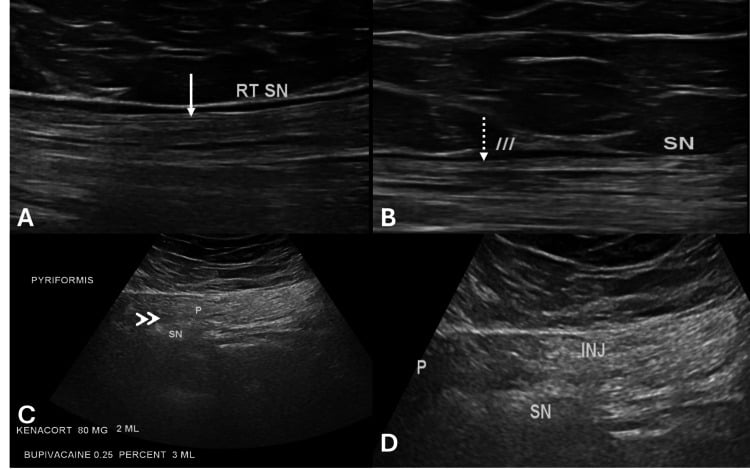 Ultrasound comparison of a normal sciatic nerve and focal compression below piriformis with an injection panel