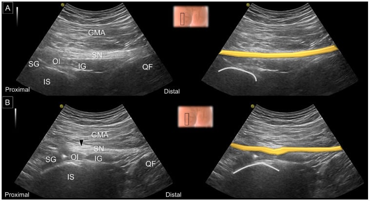 Long-axis ultrasound of the sciatic nerve in neutral position and internal hip rotation with colour overlays