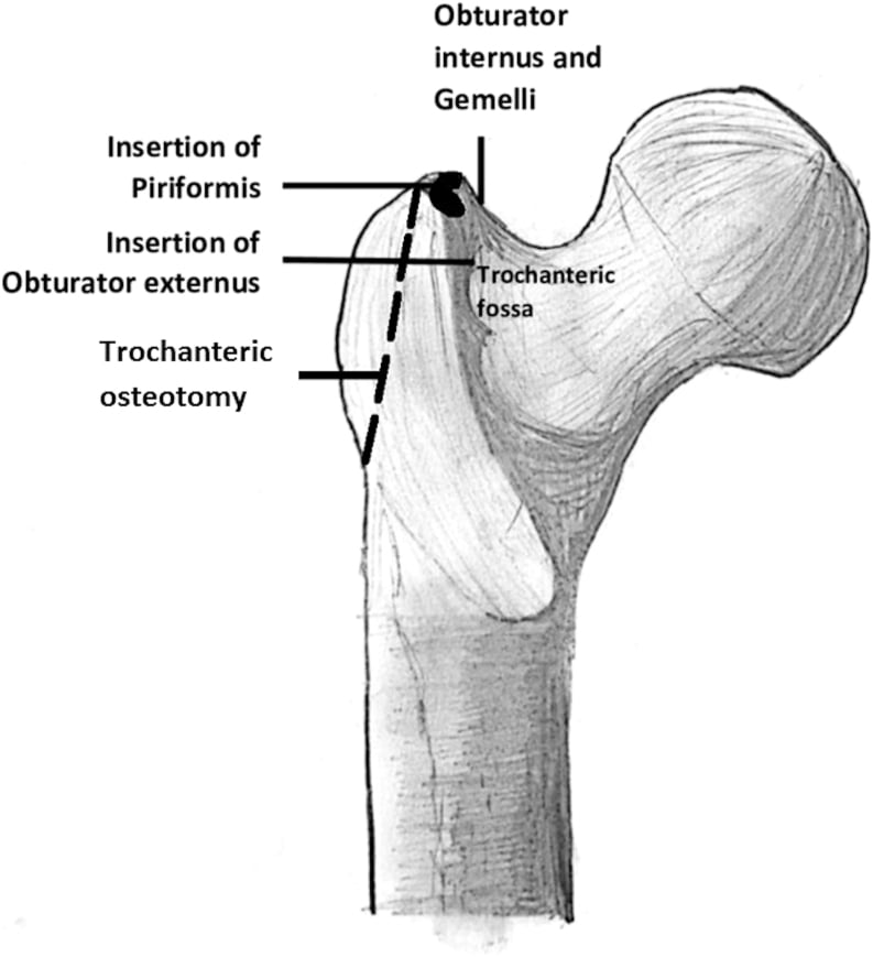 Posterior proximal femur drawing showing piriformis, obturator internus-gemelli and obturator externus insertion sites around the trochanteric fossa