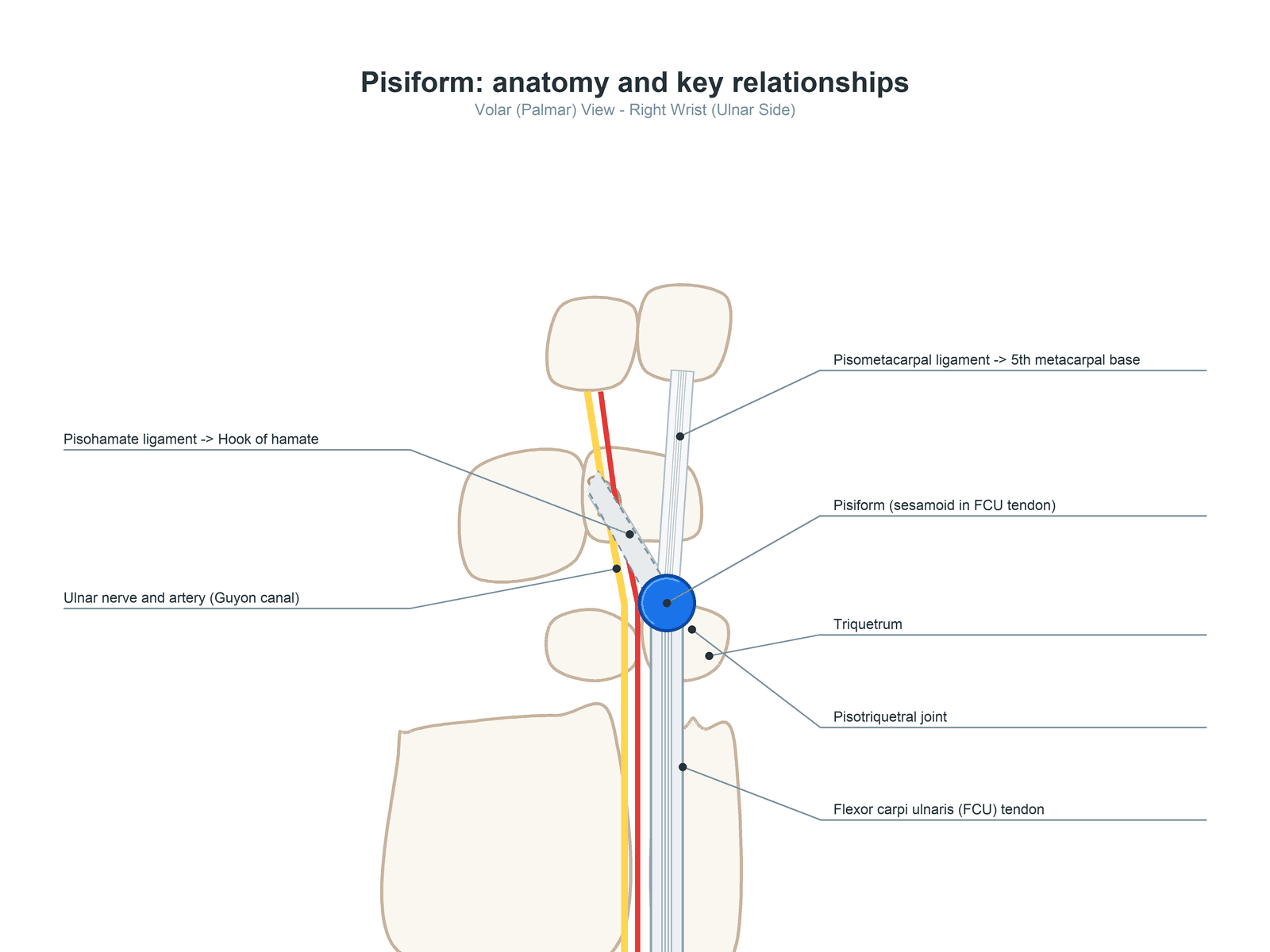 Volar anatomical diagram of the pisiform showing the pisotriquetral joint, FCU tendon, pisohamate and pisometacarpal ligaments, and the ulnar neurovascular bundle in Guyon canal