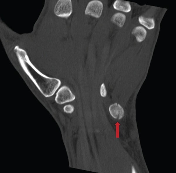 Coronal and axial CT of the wrist demonstrating a pisiform fracture that was occult on initial radiographs.