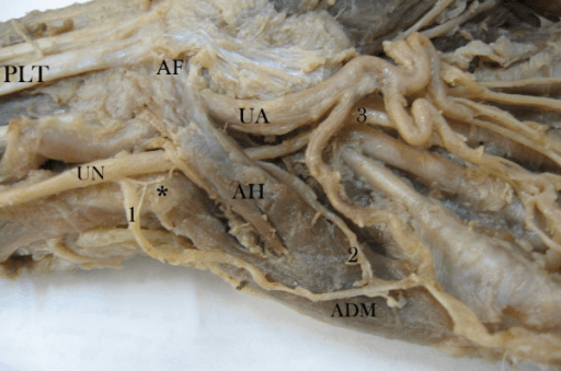 Cadaveric dissection of Guyon canal and hypothenar region
