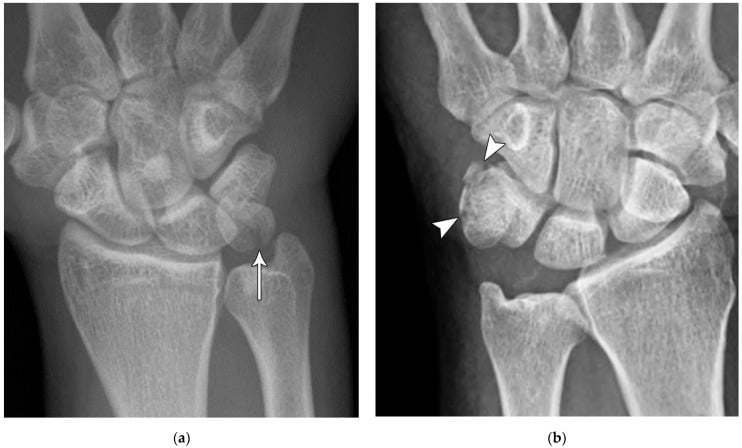 PA wrist radiographs showing a displaced pisiform fracture and a comminuted pisiform fracture.