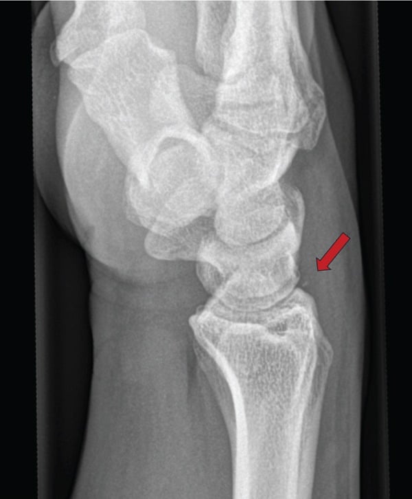 Lateral wrist radiograph showing a small ossicle adjacent to the pisiform in an acute fracture.