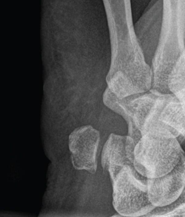 Dedicated pisiform-view radiograph after four weeks of cast immobilisation showing interval healing of a pisiform fracture.