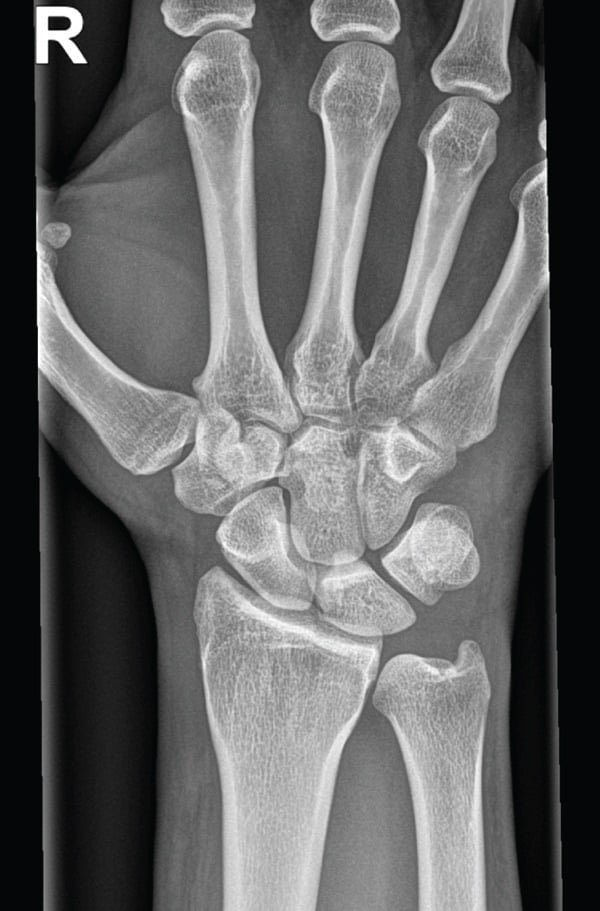 Initial AP wrist radiograph in a patient with pisiform fracture showing how the lesion can be obscured by overlapping carpal bones.