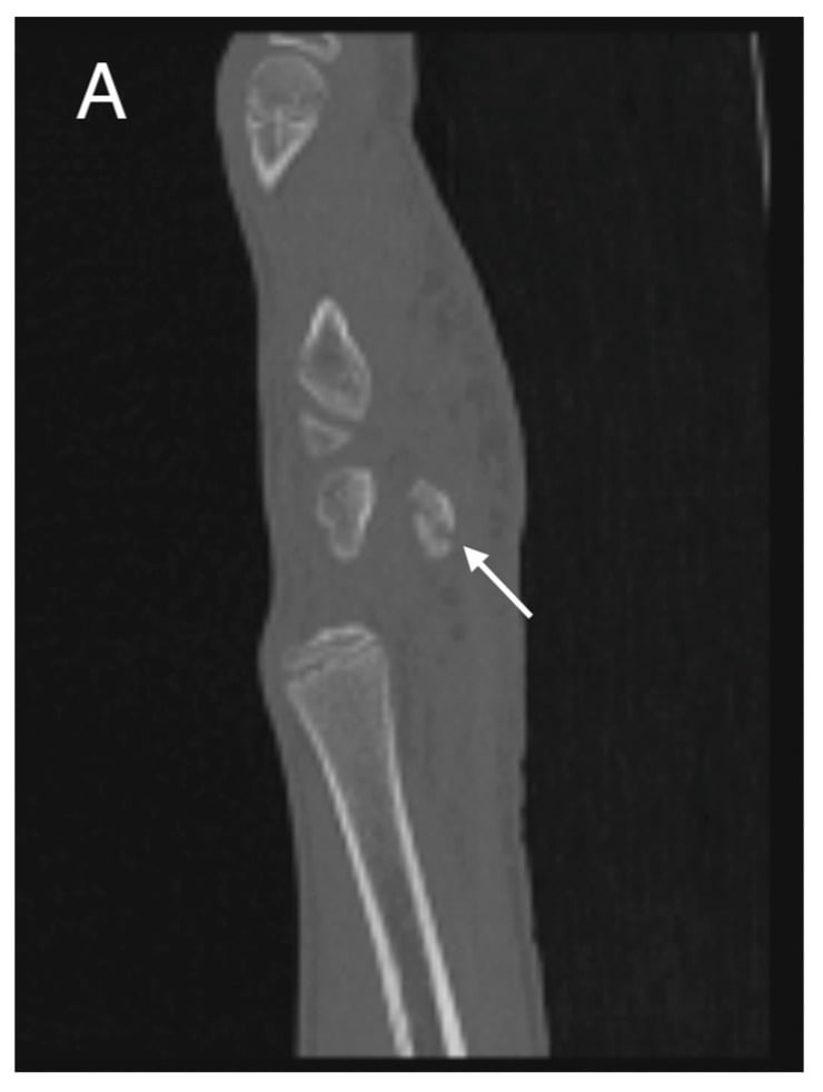 Sagittal and axial CT of a non-displaced pisiform fracture marked by arrows.